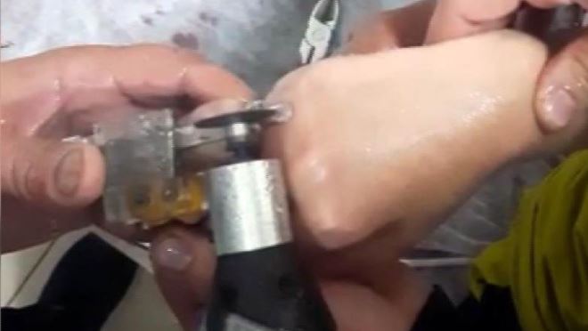 Parmağı kangren olmadan kurtardılar