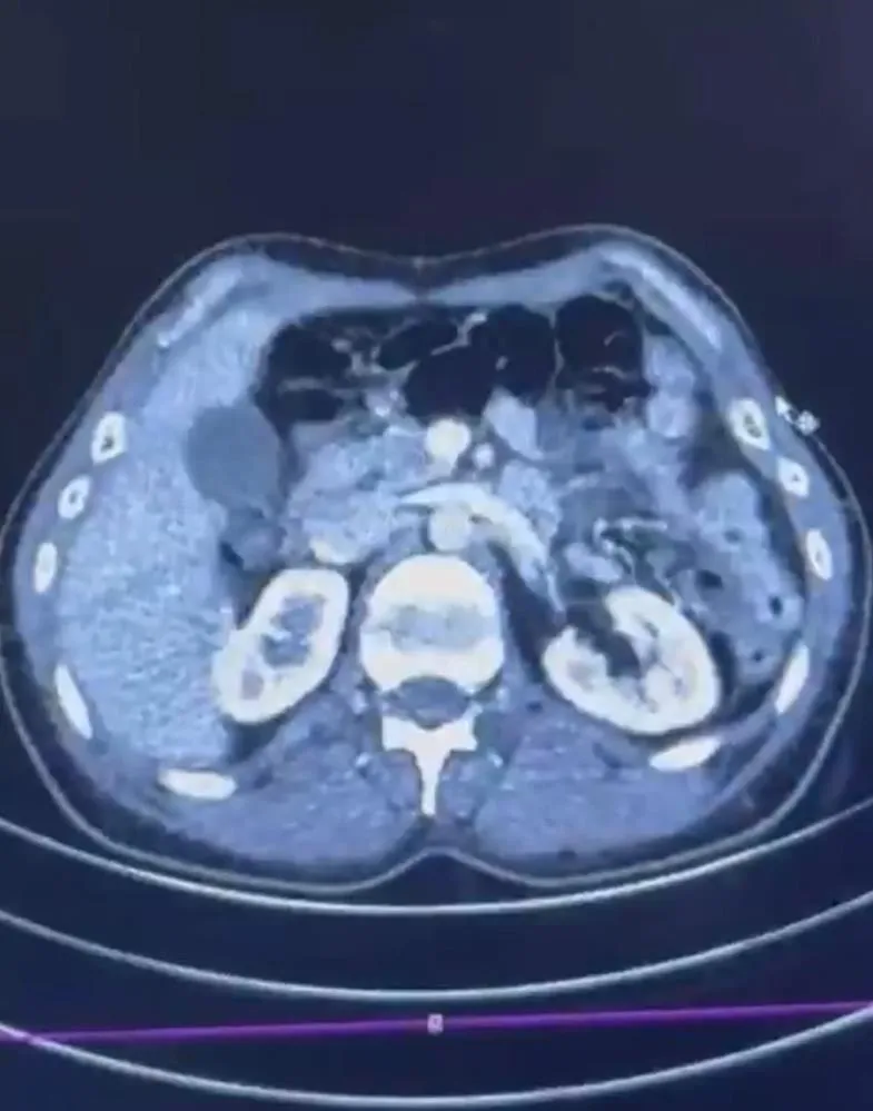 Ülkeye midelerinde uyuşturucu getirdiler!