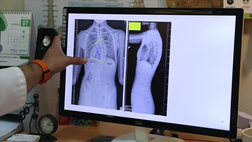 Dijital cihaz kullanımı skolyoz riskini yükseltiyor